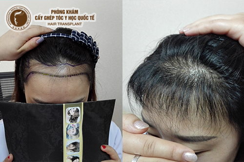 Rụng tóc mái nguyên nhân và cách điều trị hiệu quả?