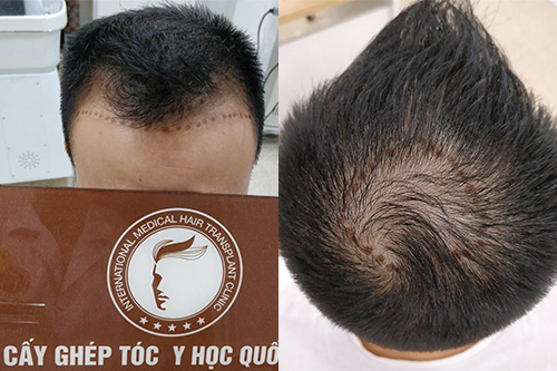 Hói đầu khi còn trẻ: Nguyên nhân và cách khắc phục triệt để