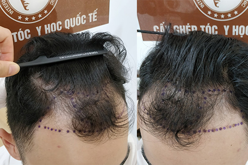 Bị hói đầu phải làm sao? Tìm hiểu dấu hiệu, nguyên nhân và cách khắc phục