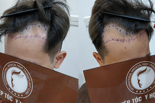 5 cách chống hói đầu đơn giản nhưng ít người để ý