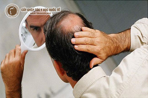 3 cách trị rụng tóc hói đầu đơn giản ngay tại nhà
