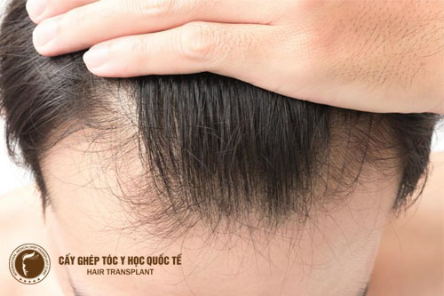 Nguyên nhân gây ra chứng rụng tóc Androgen