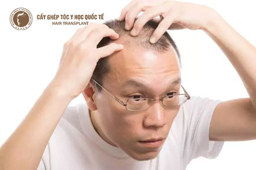 Hói đầu có trị được không? Phương pháp nào khắc phục tối ưu tình trạng này?