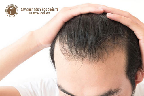 Cách trị hói đầu hiệu quả nhất hiện nay tại Việt Nam