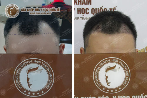 Có nên đi cấy tóc không? Cấy tóc có an toàn không?