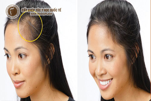 Hói đầu sớm: Nguyên nhân và cách điều trị