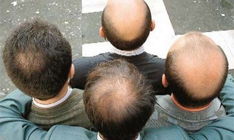 Giải đáp từ chuyên gia: “Hói đầu di truyền có chữa được không?”