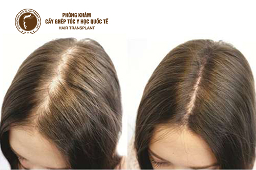 Chữa rụng tóc di truyền bằng thuốc có hiệu quả không?