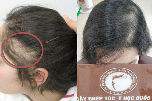 Rụng tóc và chân tóc yếu – Nguyên nhân và cách khắc phục