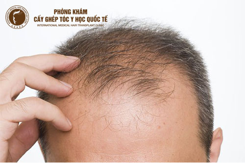 Cách chữa hói đầu ở nam giới hiệu quả nhất