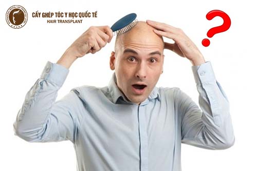 Điểm danh các cách trị hói đầu hiệu quả