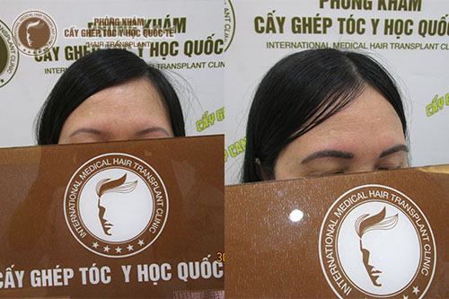 TOP 3 địa chỉ cấy lông mày tự nhiên bạn nên biết