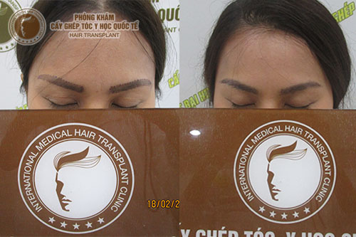 Giải đáp thắc mắc: Cấy lông mày giá bao nhiêu? 