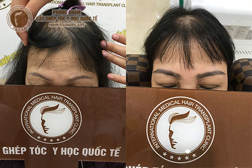 Nguyên nhân và cách khắc phục hói đỉnh đầu nữ giới