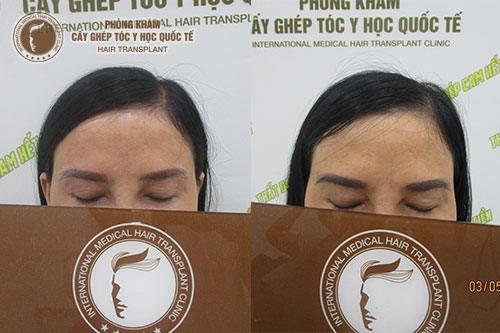 Phẫu thuật cấy lông mày có tốt không (review chi tiết)
