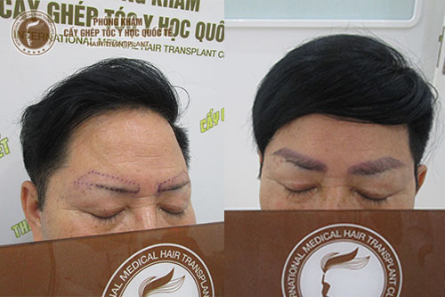 Cấy lông mày nam giới phương pháp làm đẹp cho phái mạnh