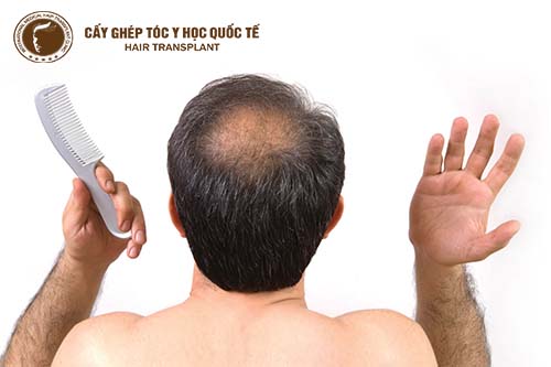 Bật mí cách chữa hói đầu hiệu quả cho nam giới