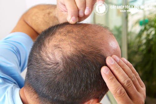 Bật mí phương pháp trị hói đầu cực kỳ hiệu quả