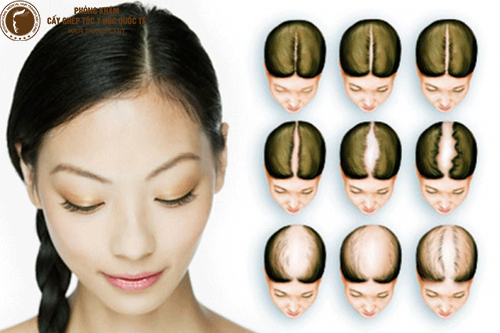 CHỮA HÓI ĐẦU: PHƯƠNG PHÁP NÀO LÀ TỐI ƯU NHẤT?