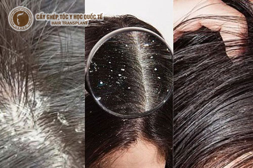 Điều trị gàu sao cho hiệu quả?