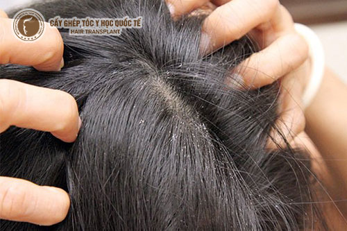 Da đầu khô thì phải làm sao?