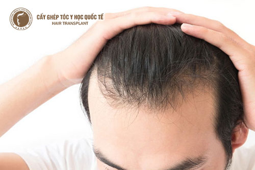 Đàn ông hói đầu có phải yếu sinh lý?