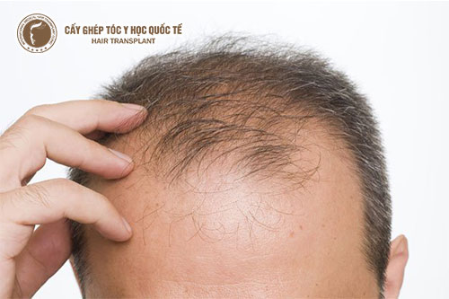 Nguyên nhân hói đầu ở nam giới và cách chữa trị hiệu quả