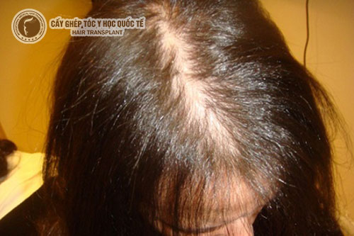 Giải đáp thắc mắc: “Bị hói đầu bẩm sinh làm sao để khắc phục