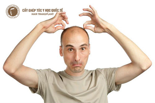Sự thật về hói đầu yếu sinh lý ở nam giới