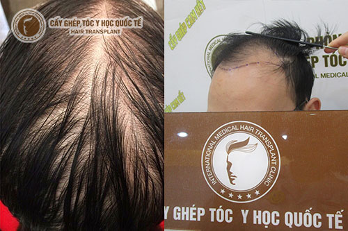 Nguyên nhân rụng tóc ở nam và nữ có giống nhau không?