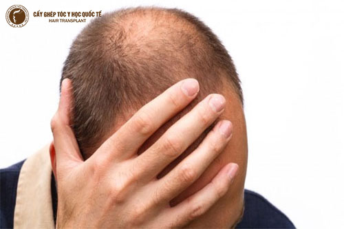 Nguyên nhân bị hói đầu ở cả nam và nữ giới