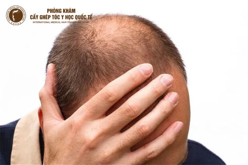 Làm gì khi bị rụng tóc đỉnh đầu