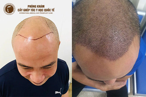 Làm thế nào để tính toán chi phí cấy tóc hết bao nhiêu tiền?