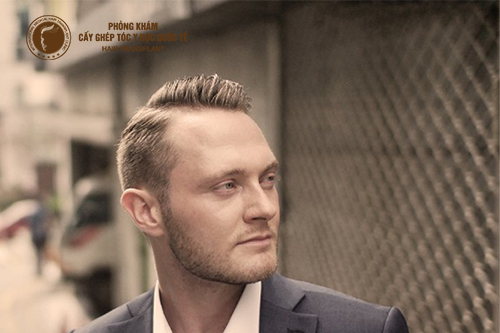 Bỏ túi 5 mẹo giúp ngăn ngừa hói đầu ở nam giới