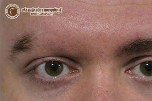 7 cách chữa rụng lông mày bằng tự nhiên an toàn và hiệu quả