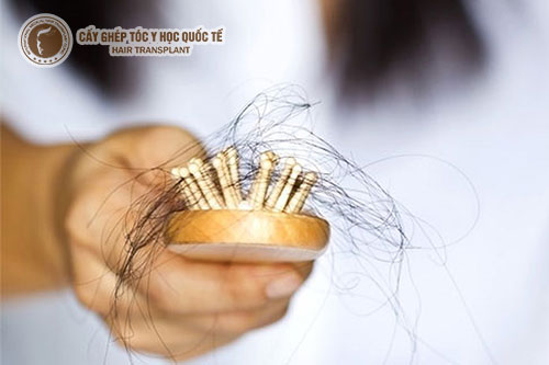 Rụng tóc cả chân có điều trị được không?