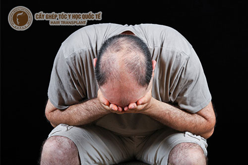 Rụng tóc di truyền là gì, có khắc phục được không?