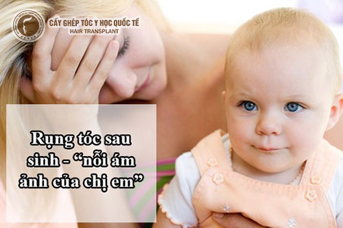 Rụng tóc sau sinh quá nhiều do đâu?