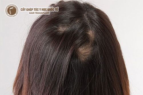 Cách trị rụng tóc ở tuổi dậy thì an toàn và hiệu quả