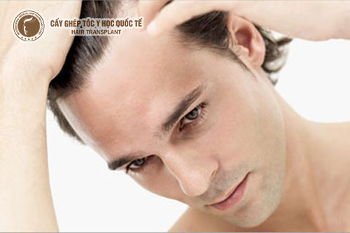 Những ai cần cấy đường chân tóc?