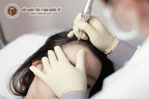 Cấy đường chân tóc có đau không?