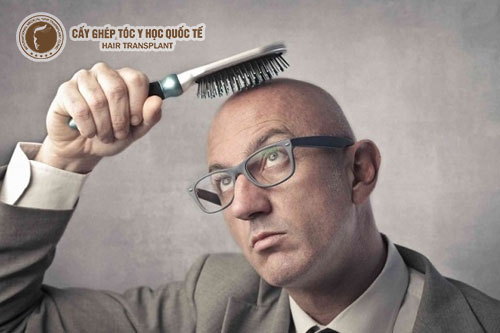 Giải đáp câu hỏi: Hói đầu phải làm sao?