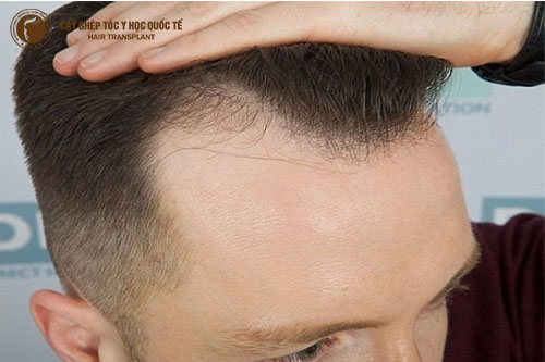 Những ai cần cấy tóc chữ M?