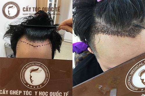 Giải đáp: Tóc đường chữ M là gì? Cấy tóc đường chữ M như thế nào?