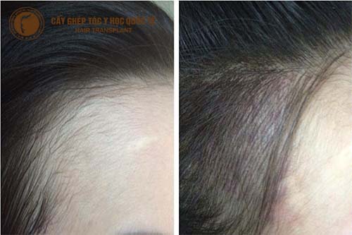 Địa chỉ cấy đường chân tóc tại HCM uy tín, hiệu quả