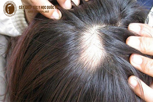 Cách trị hói đầu hiệu quả nhất hiện nay