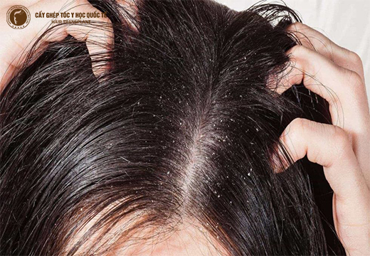 Trị rụng tóc và gàu với 3 cách cực đơn giản tại nhà