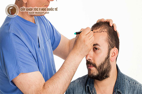 Xua tan nỗi lo hói đỉnh đầu ở nam giới