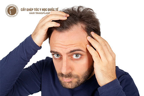 Cách chữa hói trán nhanh và hiệu quả nhất cho nam giới