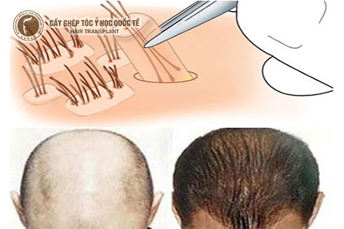 Tất tần tật về công nghệ cấy tóc Hàn Quốc